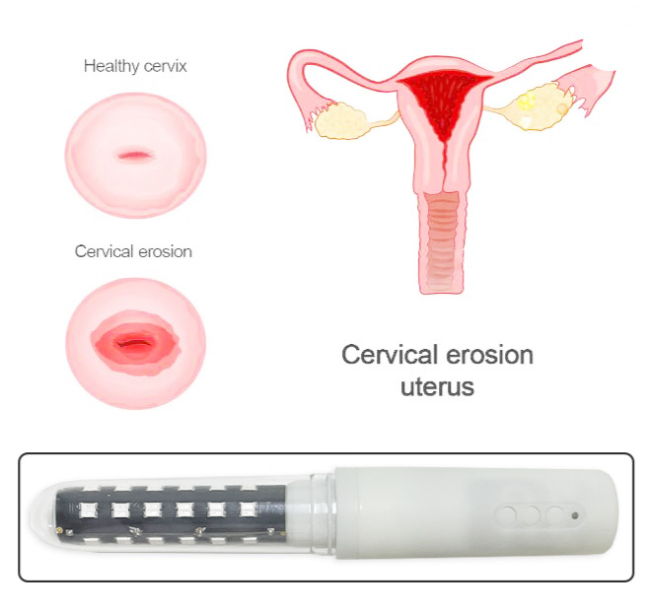 660nm 450nm 650nm Laser Light Therapy  Vaginal Tightening Wand
