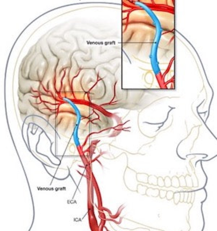 COZING Photobiomodulation Helmet – Advanced Neurological Therapy Device