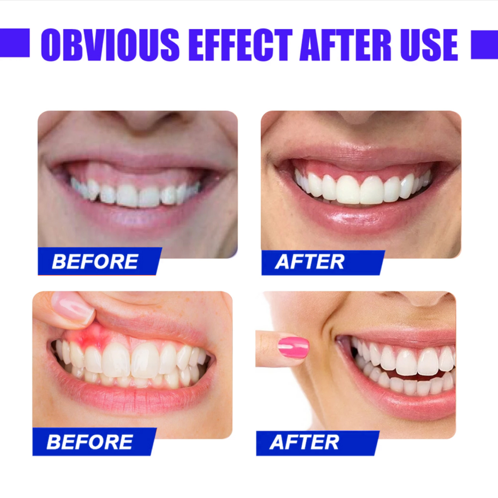 Oral Red Light Therapy Device – 625nm LED for Tooth Sensitivity, Gum Inflammation