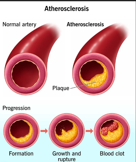 How does the COZING-WS11/11H/WS12/13 laser therapy device help prevent and treat atherosclerosis?cid=3