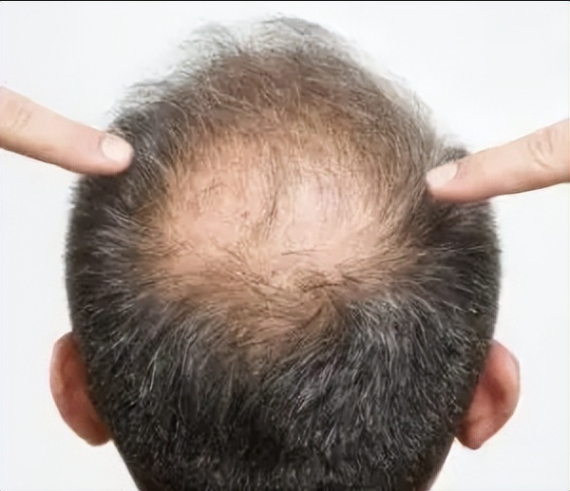 Norwood-Hamilton Male Pattern Baldness Classification Standard: